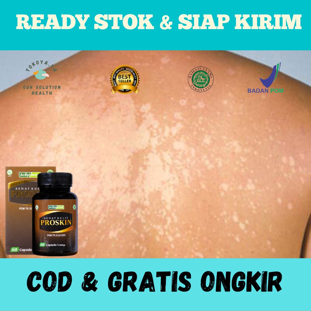 Obat Panu, Obat Menghilangkan Panu, Obat Ngilangin Balas Bogo, Obat Penghilang Balas Bogo Di Wajah, 