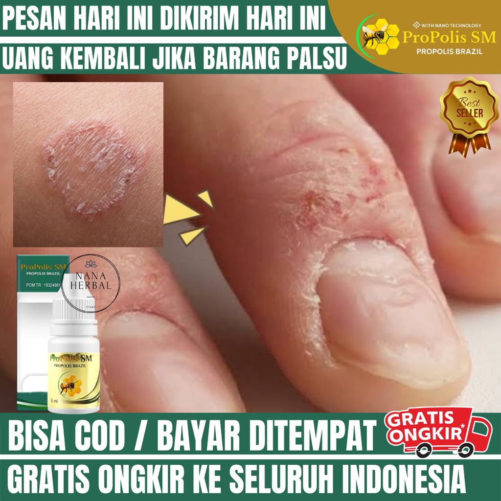 OBAT KURAP, OBAT INFEKSI JAMUR, OBAT RUAM MERAH DAN GATAL, OBAT GATAL KURAP, OBAT ANTIJAMUR, OBAT HA