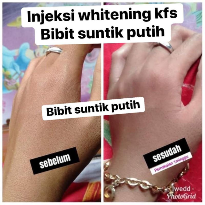 Injeksi Whitening KFS