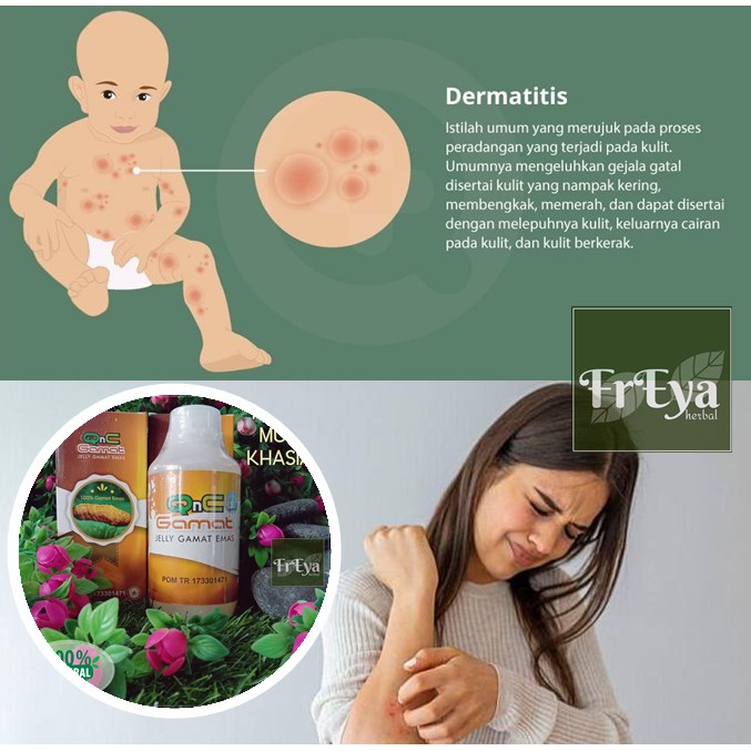 OBAT DERMATITIS, OBAT HERBAL EKSIM, OBAT EKSIM KERING, OBAT EKSIM BASAH (BISA COD)