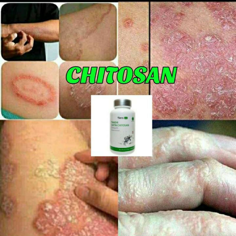 (COD)CHITIN CHITOSAN TIENS ATASI PENYAKIT GATAL,EKSIM,EXSIM,BOROK,KORENG,PANU,KURAP,KUDIS