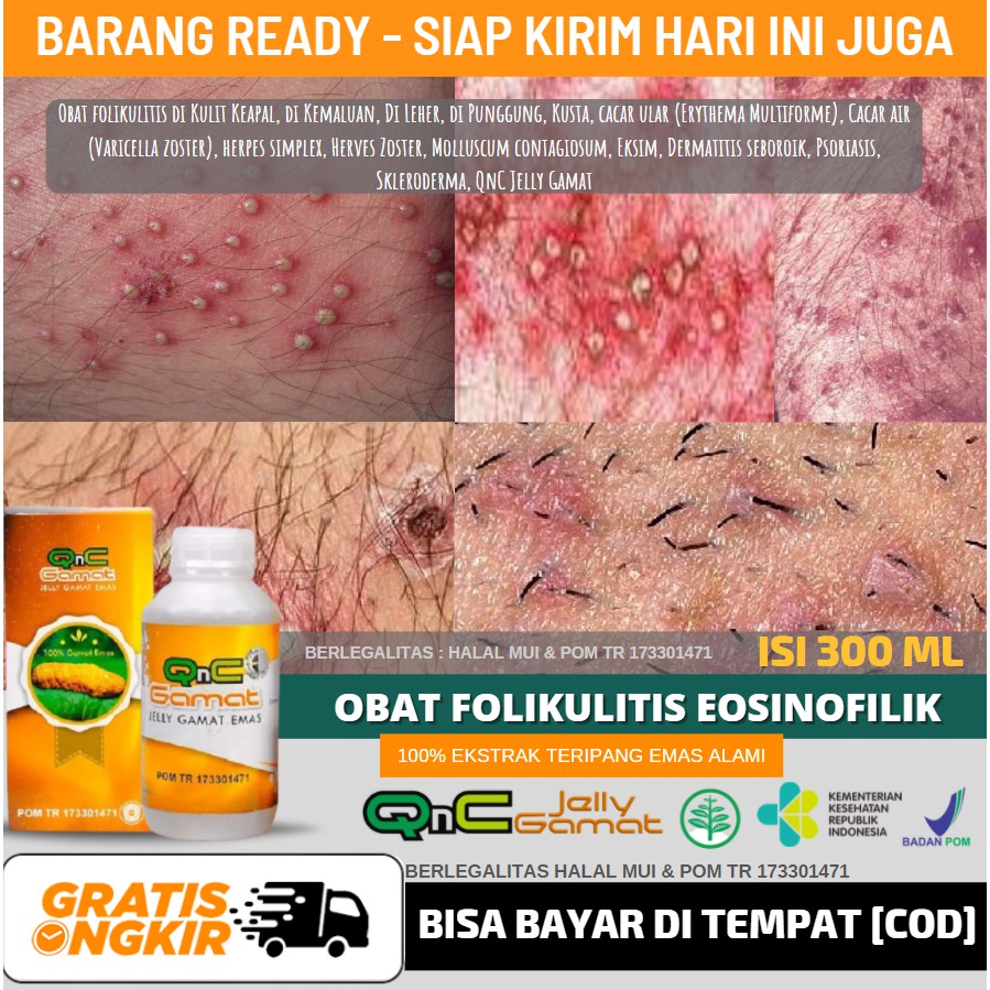 Obat Alami Folikulutis di Kelamin, Folikulitis di Pantat, Folikulitis di Rambut Kelamin, QnC Gamat