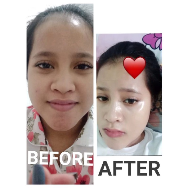 Krim malam normal / Krim malam acne
