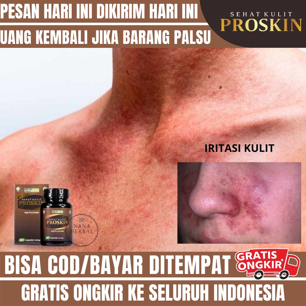 Obat Iritasi Kulit, Obat Ruam Kulit Dewasa, Obat Kulit Gatal Berair, Obat Herbal Kulit Gatal Dan Ker