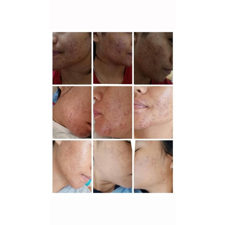 (New FORMULA)ORI!! KALEY Pineapple-c Lightening Essence Serum Nanas vitamin c acne perawatan wajah-4