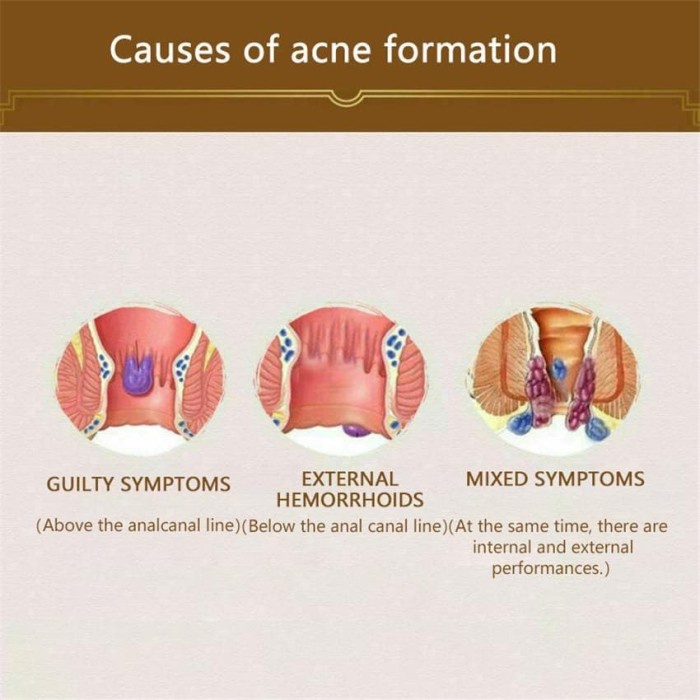 [BELI 1 GRATIS 1]DICTAMNI OBAT HERBAL WASIR DICTAMNI SALEP OBAT WASIR TERLARIS