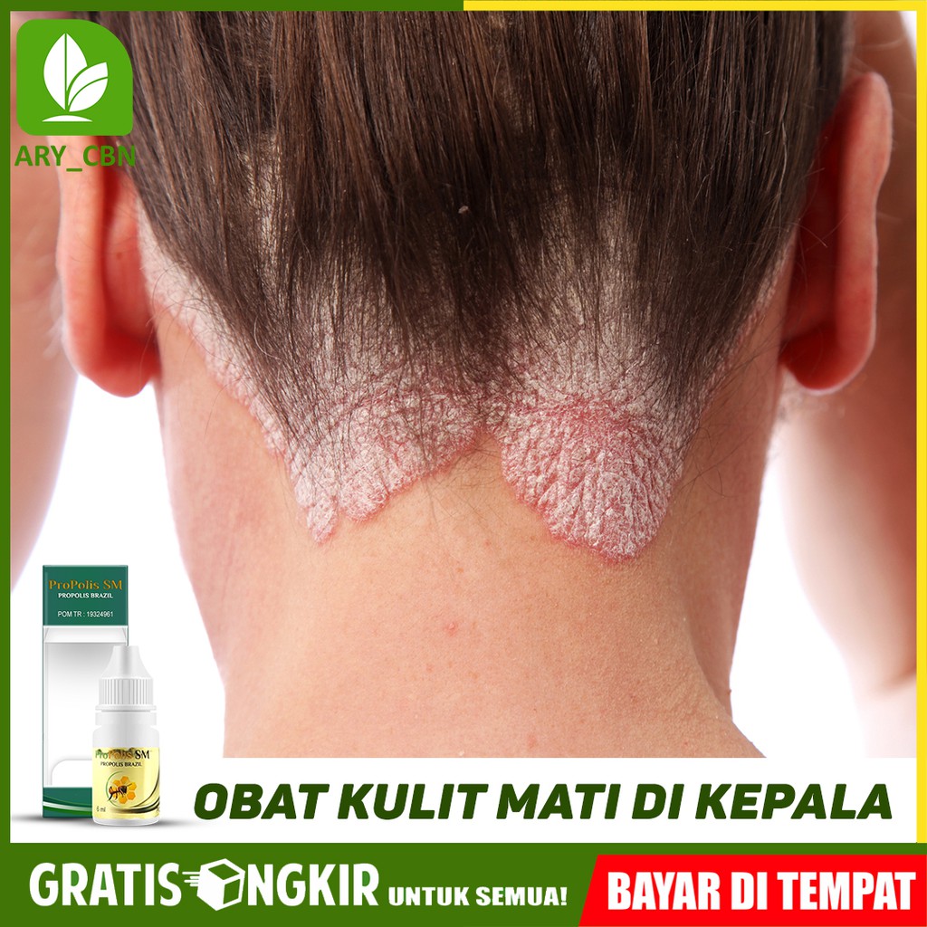 

Obat Kulit Mati Di Kepala Ketombe Berkerak Perah Yang Aman Herbal PROPOLIS SM Di Cirebon Bisa COD