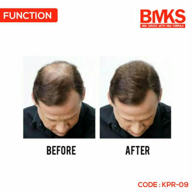 MINYAK KEMIRI BMKS MENGATASI RAMBUT RONTOK