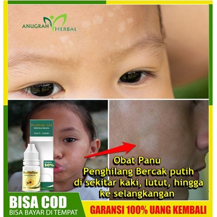 Obat Panu -/- Penghilang Bercak putih di sekitar kaki, lutut, hingga ke selangkangan | Obat Oles unt