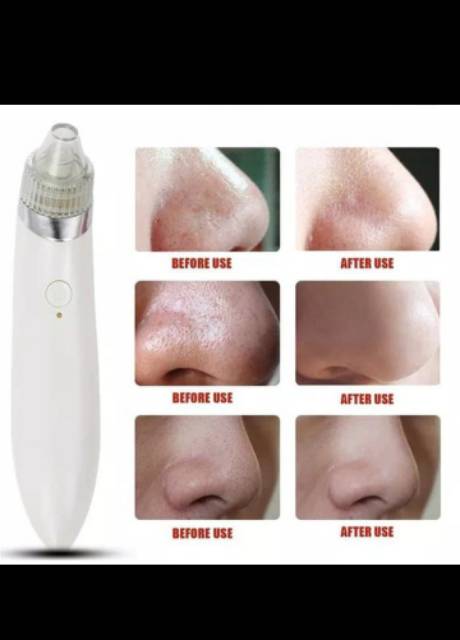 Alat Mesin Penyedot Komedo Blackhead Cleaning Auto Promover XN 8030