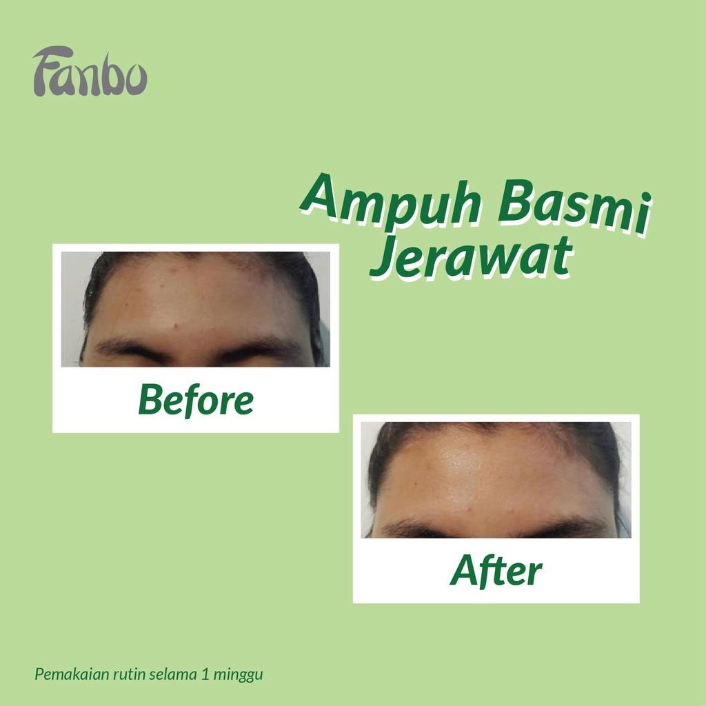 ★ BB ★ Fanbo Acne Solution Gel 20g - Krim Totol Atasi Jerawat