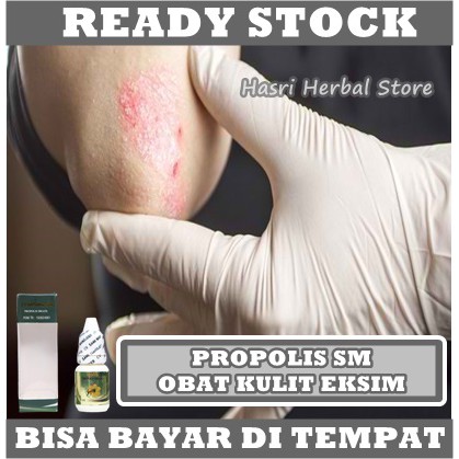 Obat Eksim, Kering, Basah, Menahun, Selangkangan, Herves, Bekas Luka, Kanker Kulit, Gudik, Cacar Air, Gatal-Gatal, Alergi, Bernanah, Panu, Kadas, Kurap, Propolis SM Brazil Asli 100% Original Tanpa Efek Samping Apapun