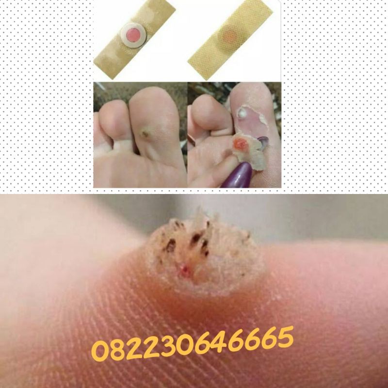 Plester Kutil Ji Yan Gao isi 6 plester