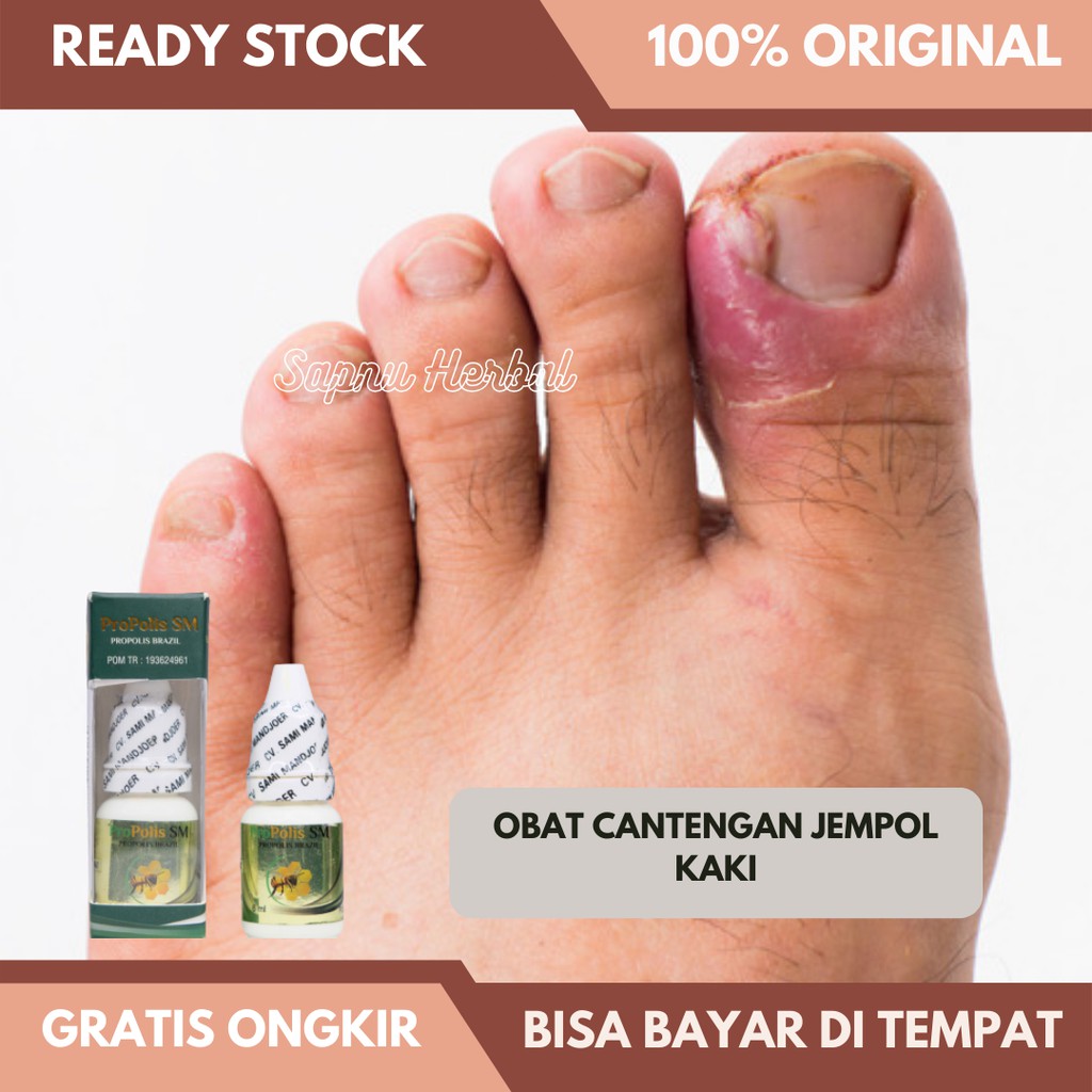 Obat Cantengan Jempol Kaki - Obat Jamur Kuku - Obat Kuku Bernanah