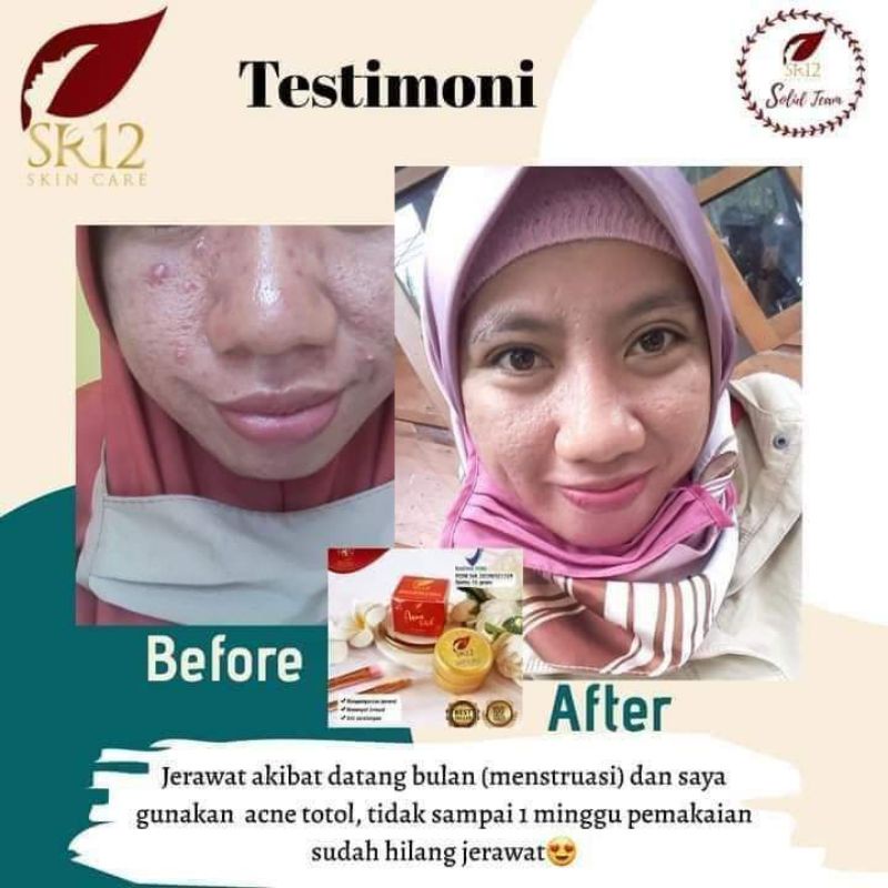 SR12 ACNE TOTOL SR12 / OBAT JERAWAT / OBAT JERAWAT AMPUH / KEMPESKAN JERAWAT AMAN BUMIL &amp; BUSUI