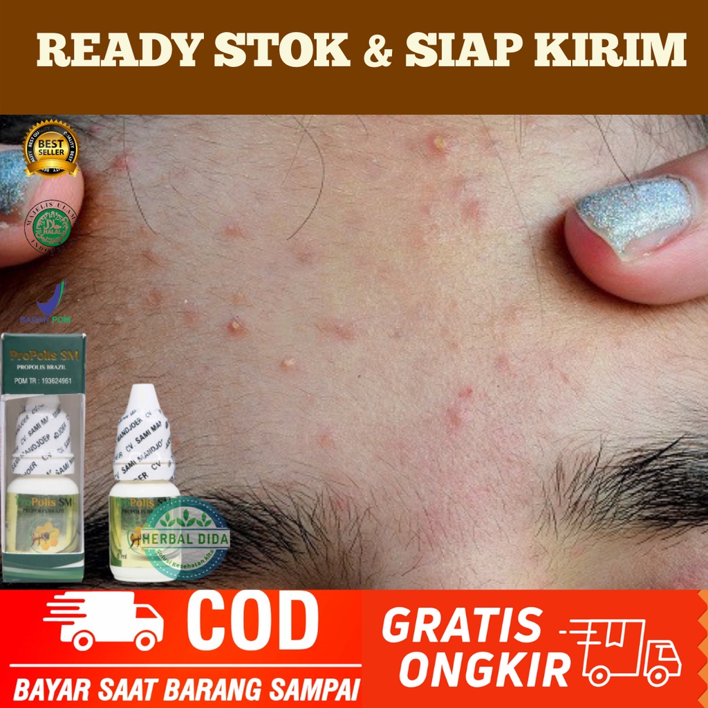 PROPOLIS SM 100% ORIGINAL, Obat Oles Penghilang Bruntusan Di Wajah, Obat Herbal Penghilang Bruntusan