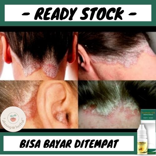 Obat Ketombe, Obat Ketombe Parah, Obat Ketombe Kering, Obat Pembasmi Ketombe, Obat Ketombe Parah, Ob