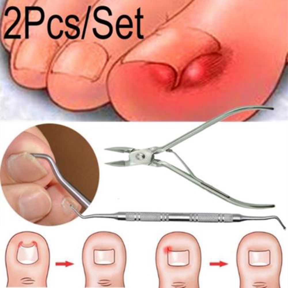 2pcs Set Korektor Kuku Jempol Kaki Untuk Pedicure Shopee Indonesia