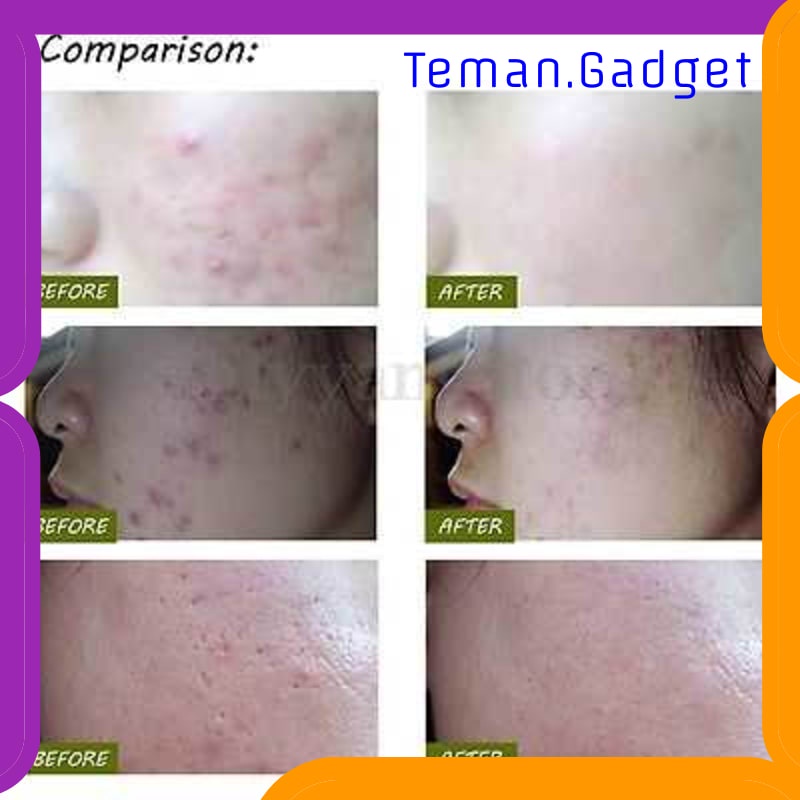 TG-FE193 LAIKOU PEN LED BIRU LASER PENGHILANG JERAWAT ACNE TREATMENT - KD-7910