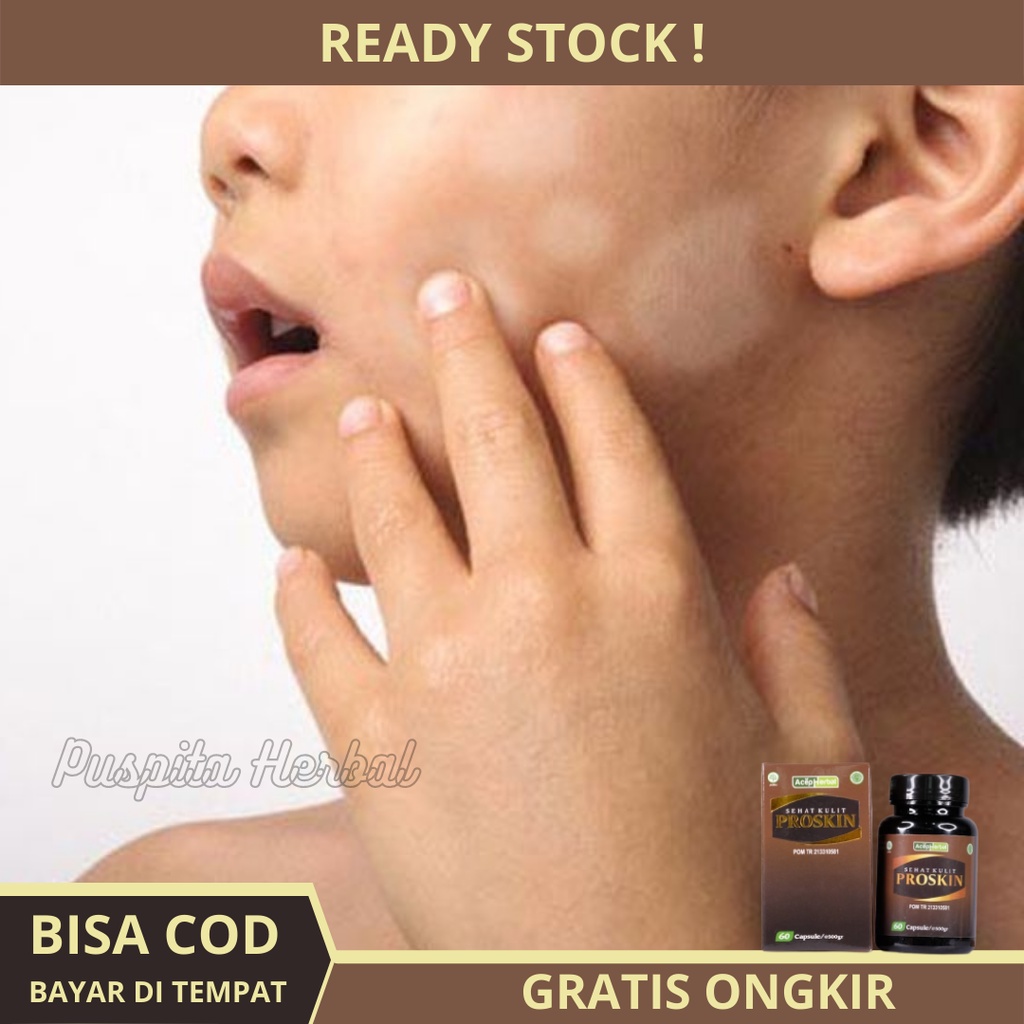 Obat Balas Bogo Untuk Anak Dan Dewasa, Panu di Wajah, Hapuran Kulit, Penghilang Panu di Kulit Wajah 