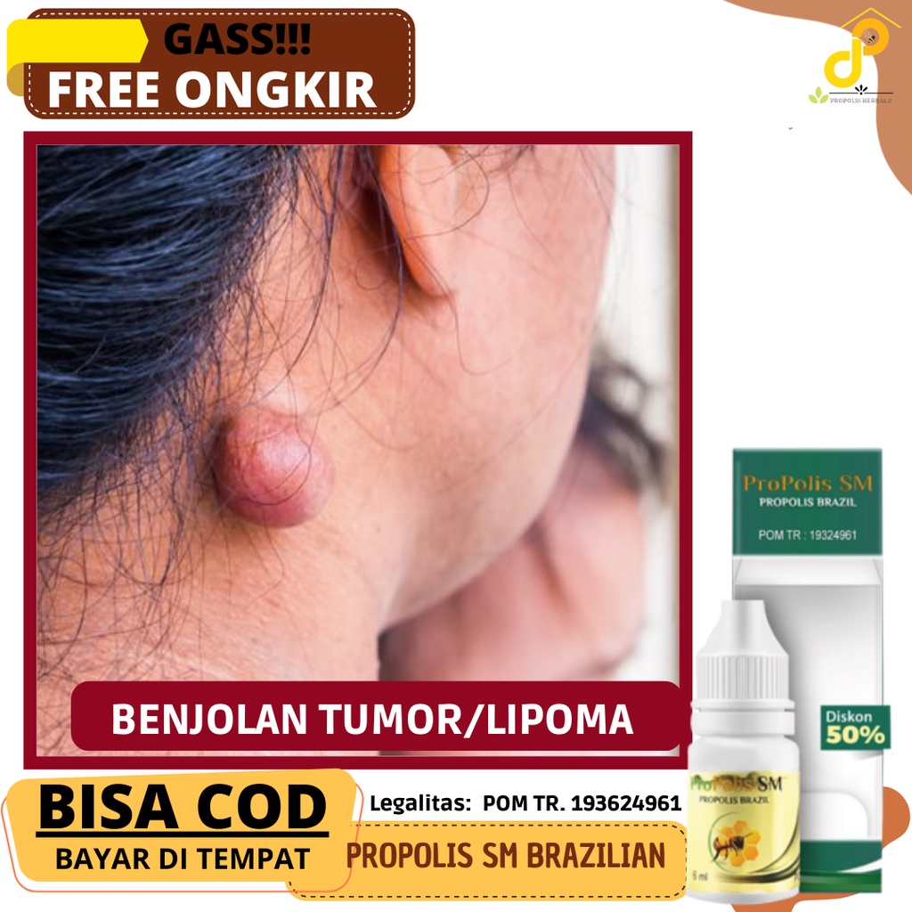 Obat Pengempes Benjolan di leher, Benjolan di sekitar ketiak, Tumor jinak, Bentol tumor, Obat Tumor 