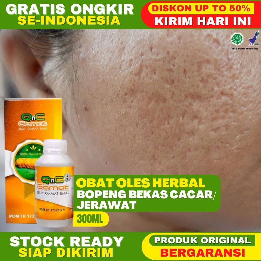 Obat Penghilang Bopeng Bekas Cacar Bopeng Bekas Jerawat Penghilang Bekas Cacar Salep Jeli QnC Jelly 