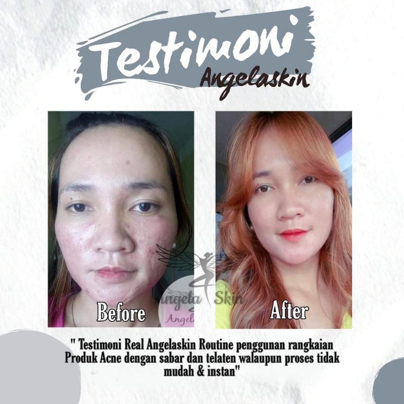 Angela Skin Paket Acne