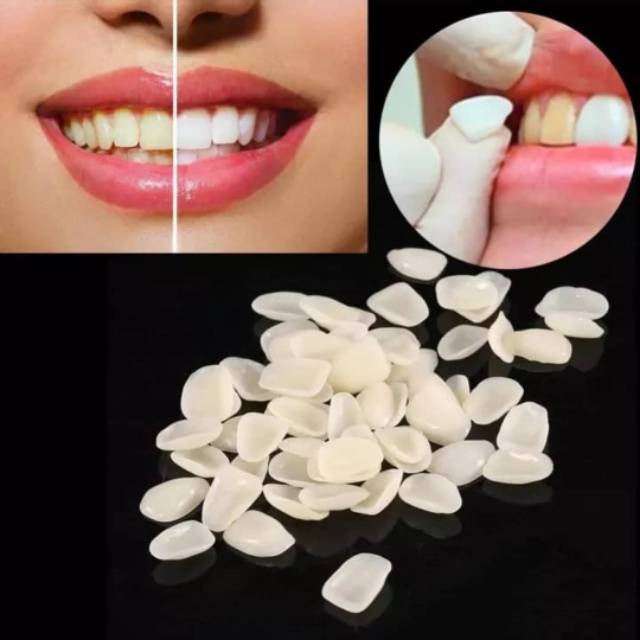 Veneer Gigi Kelinci