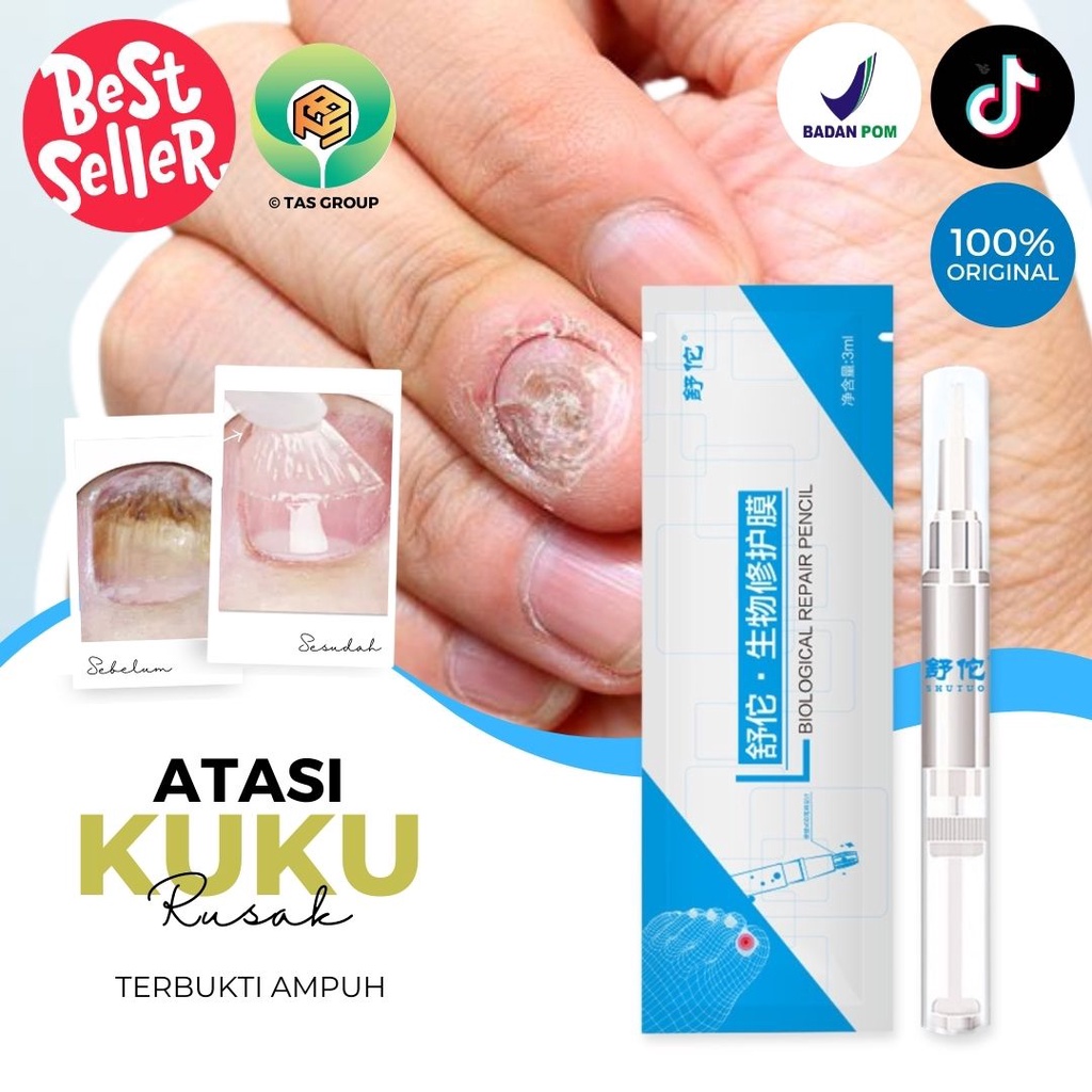 Obat Kuku Jamur Dan Rusak Busuk Berjamur Jamuran Paling Ampuh