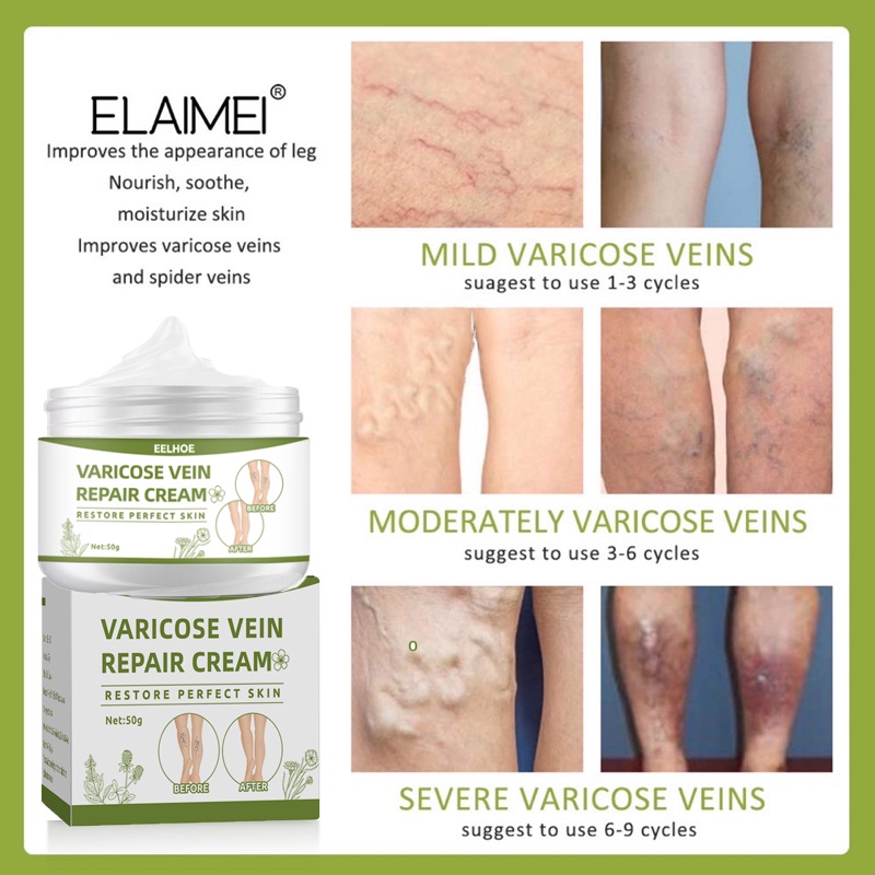 Obat Varises Salep Varises Cream Varicose Veins Varikokel Bengkak Benjolan Buah Zakar Nyeri Testis Vaskulitis Flebitis Pengobatan Vaskulitis Salep