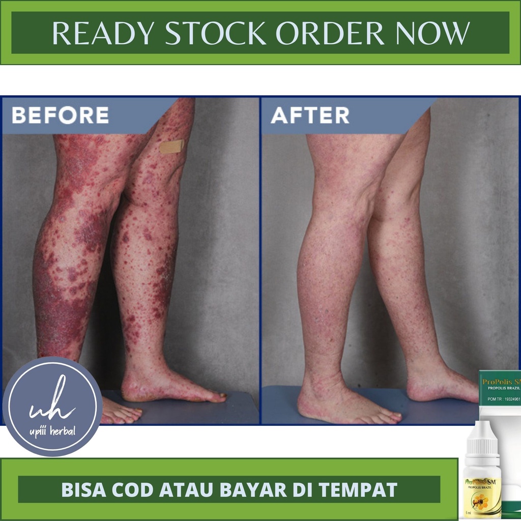 OBAT PSORIASIS VULGARIS, OBAT UNTUK PSORIASIS VULGARIS, OBAT PSORIASIS KUKU, PSORIASIS DI WAJAH, DI 