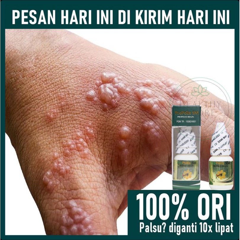 Obat Herpes Kulit / Cacar air - Obat Gatal Berair - Obat Gatal Bernanah - Obat Scabies Manusia
