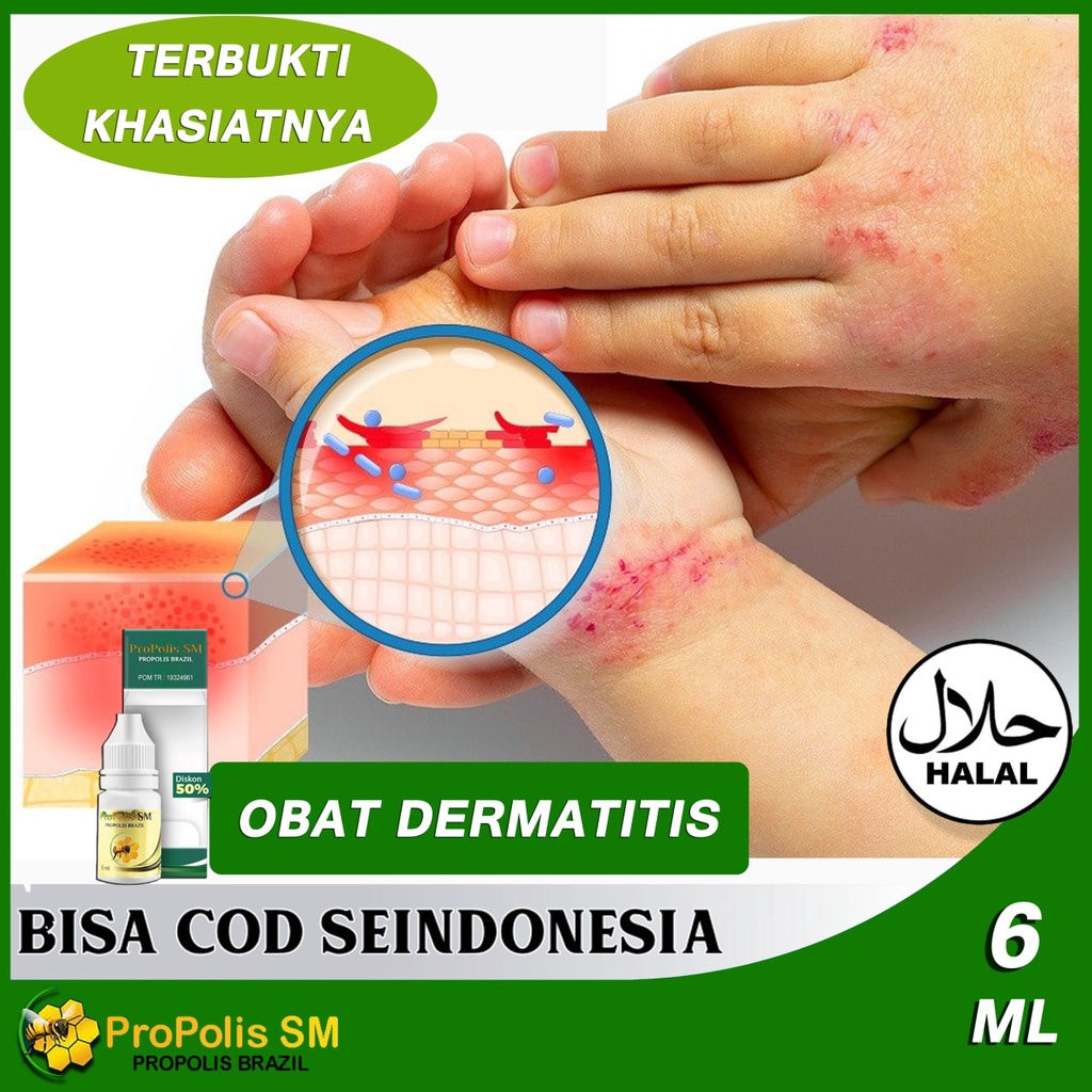 Obat Dermatitis Seboroik Homecare24 