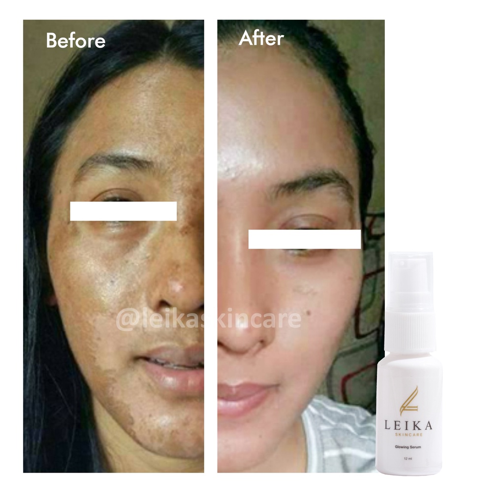 Asli Serum Flek Hitam Ampuh Skincare Penghilang Flek Hitam Di Wajah Perawatan Kecantikan Wajah BPOM 