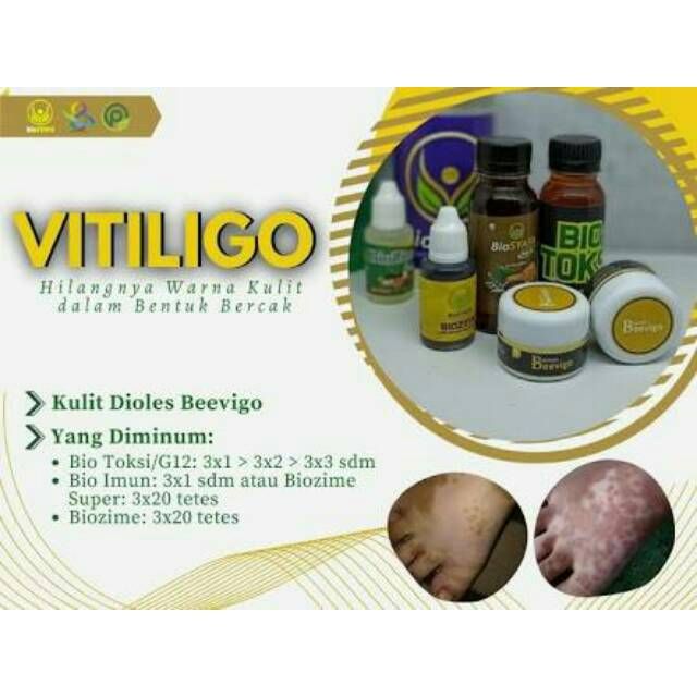BioSyafa BEEVIGO Cream Vitiligo Untuk luka Bakar keloid
