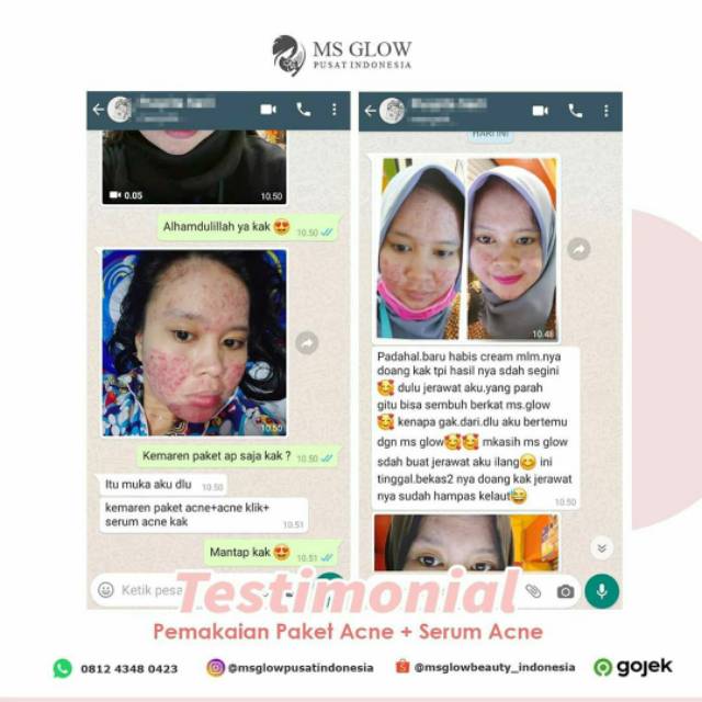 Ms Glow #Free Gift Acne Series Original Barcode Msglow Original - Paket Acne Basic (Paket Jerawat)-6