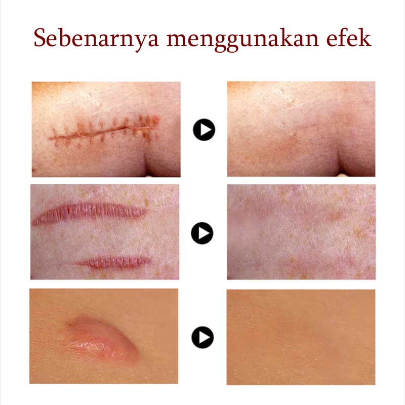 Krim Cream Salep penghilang luka bekas Menghilangkan stretch mark Penghilang bekas luka yang ampuh Memperbaiki bekas luka bakar Bekas Jerawat Bekas luka lama Benjolan dan jerawat 50G