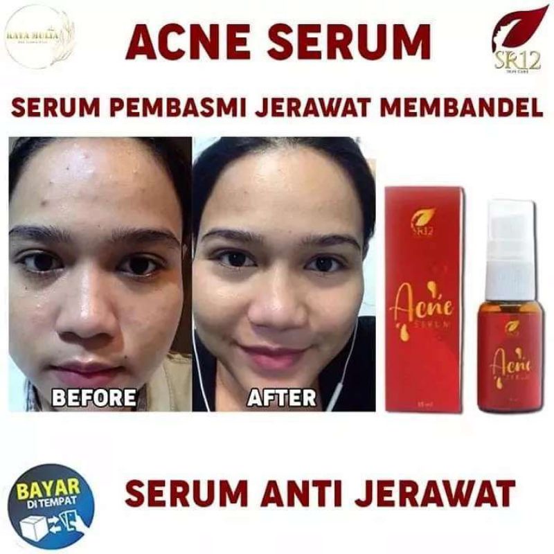 ACNE SERUM SR12 / MENYEMBUHKAN JERAWAT / BERUNTUSAN / MENGHILANGKAN BEKAS JERAWAT