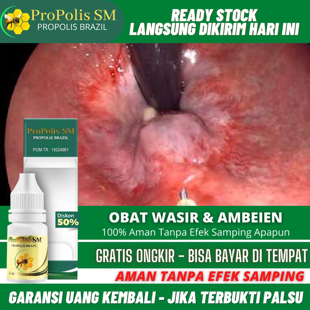 Obat Wasir Ambeien, Obat Wasir, BAB Berdarah, Benjolan Di Anus, Obat Ambeien Stadium 1-4, Sembelit, 