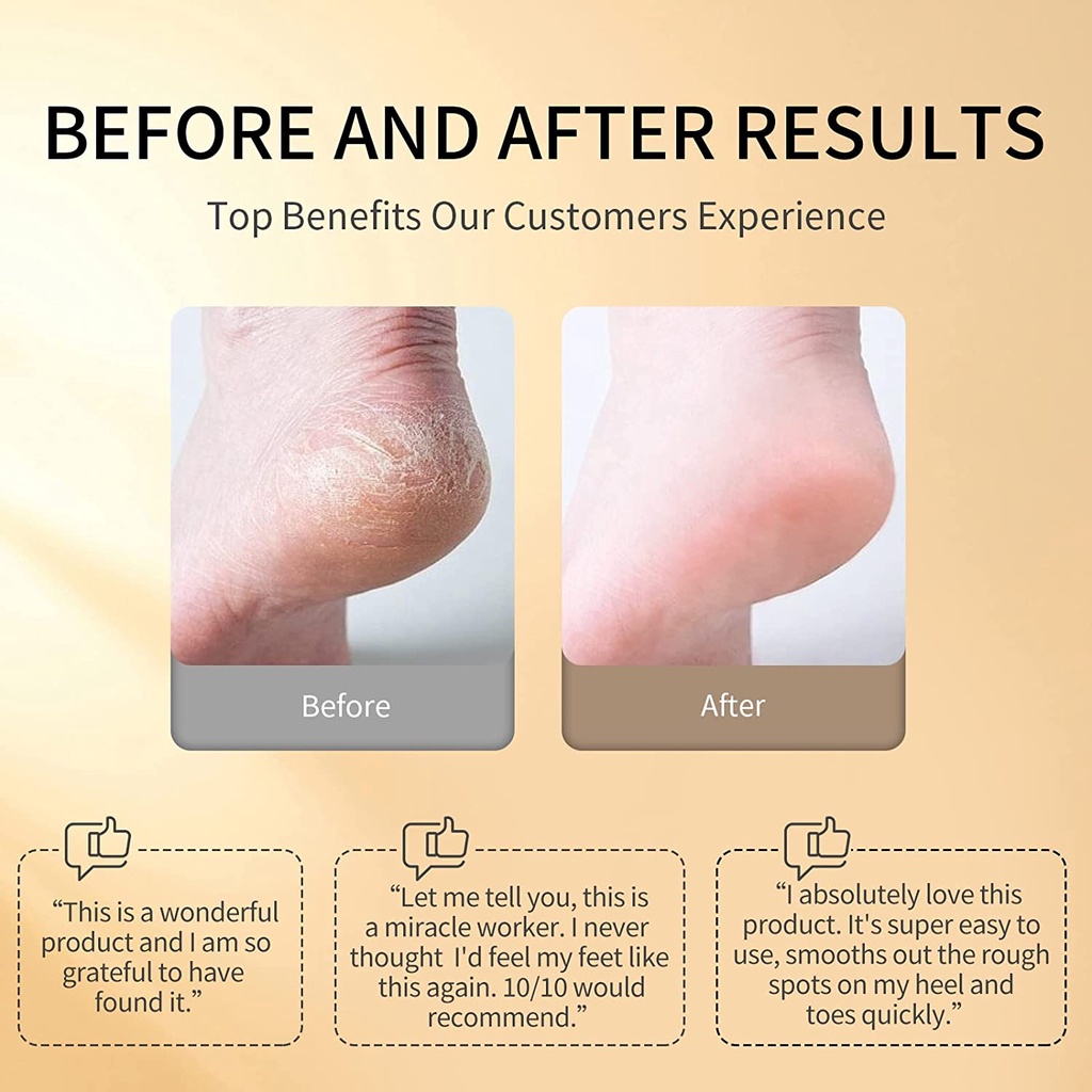 ShowSee Callus Remover Electric Pedicure Dead Skin Remover for Feet