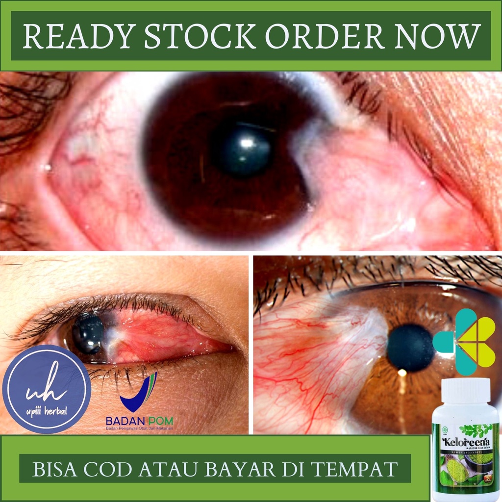 Obat Mata Berlemak, Obat Herbal Penghilang Lemak Di Mata, Obat Penyakit Mata Pterygium, Obat Lemak D