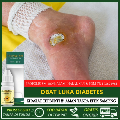 Obat Pengering Luka Untuk Penderita Diabetes - Luka Diabetes Di Kaki, Obat Penyakit Gula, Nyeri Kron
