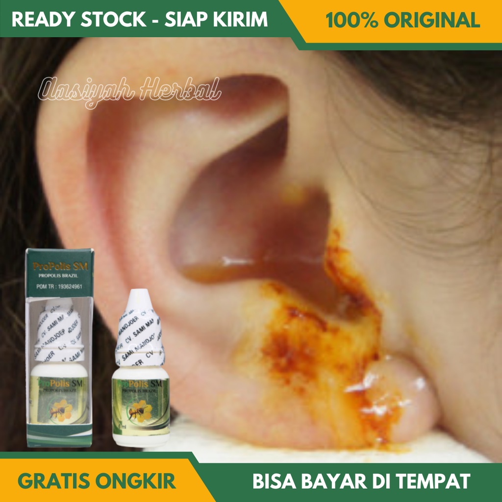 Obat Congek Menahun, Obat Telinga Bernanah, Obat Telinga Berair, Obat Telinga Sakit, Obat Telinga Ga