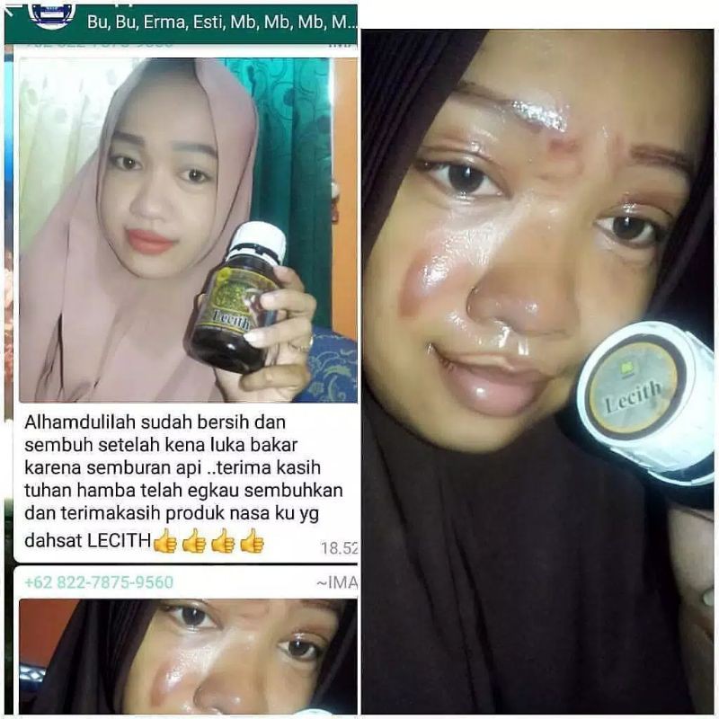 BISA COD LECITH 20ML PENGHILANG KELOID BEKAS LUKA