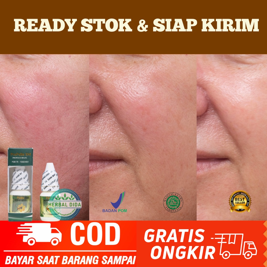 PROPOLIS SM 100% ORIGINAL BPOM, Obat Herbal Penghilang Urat Halus Di Wajah (spider veins), Obat Peng