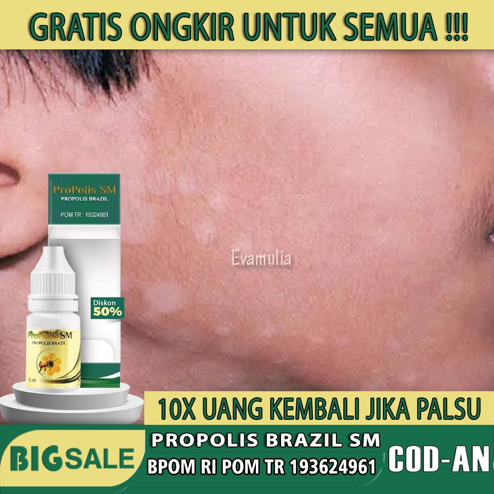 Obat Bercak Putih di Wajah - Panu di Punggung - Hapur ditubuh - Jamur Kulit Selangkangan - Kurap Kep