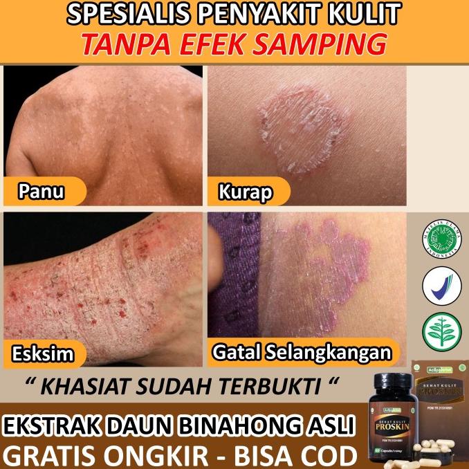 

Discount Obat Panu Kurap Eksim Gatal Kulit Selangkangan Herbal PROSKIN Asli /OBAT HERBAL ASAM URAT/OBAT HERBAL PELANGSING/OBAT HERBAL KOLESTEROL/OBAT HERBAL DIABETES
