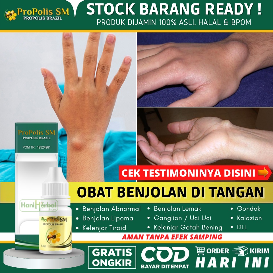 Obat Untuk Menghilangkan Benjolan Lipoma di Tangan 100% Alam, Obat Oles Benjolan di Tangan, Salep Pe