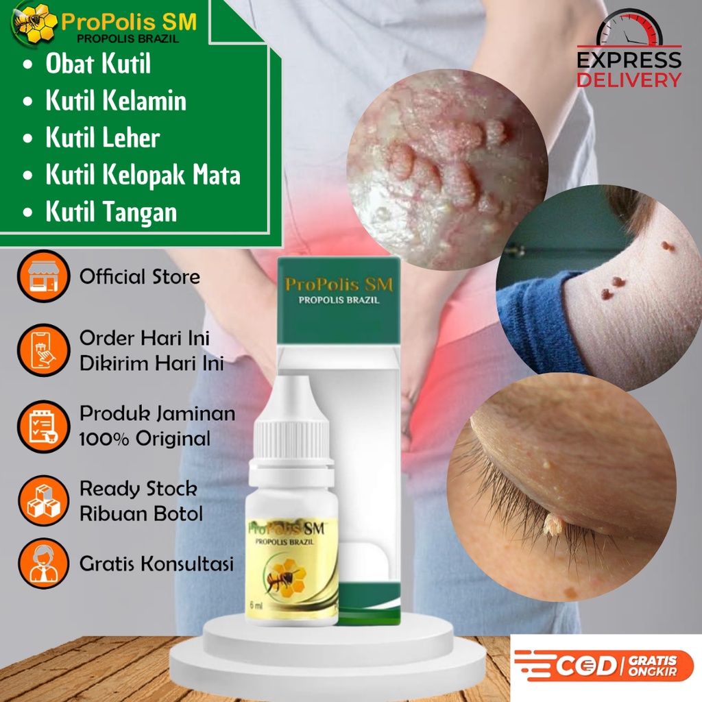 Obat Kutil Penghilang Kutil Kelamin Leher Tangan Kelopak Mata Propolis SM Multikhasiat 100% Asli Sud