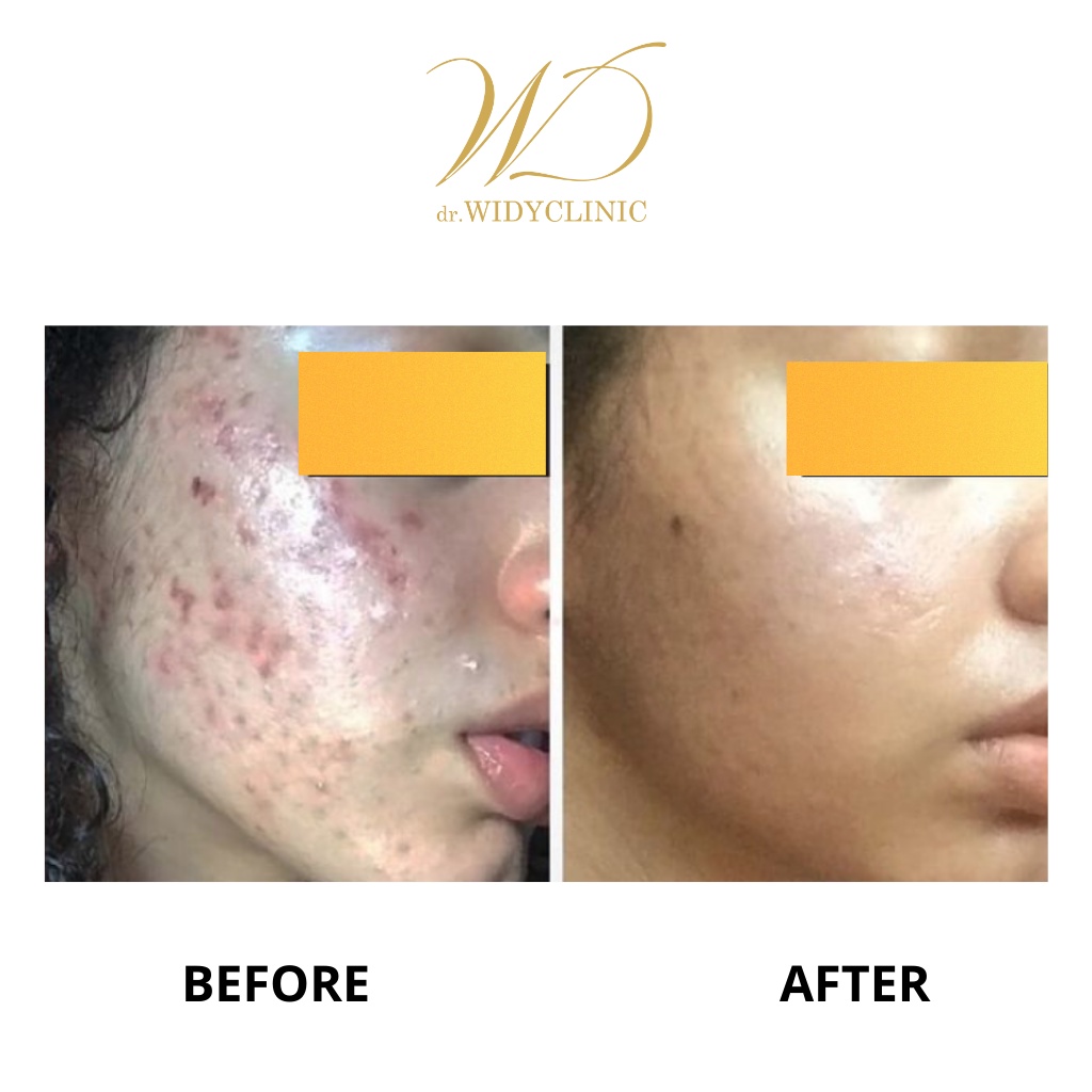 Dr Widy Clinic Acne Skincare | Paketan Jerawat &amp; Beruntusan Untuk Semua Jenis Kulit | BPOM &amp; Halal MUI Formulasi Dokter | Bekas Jerawat Mencerahkan Glowing